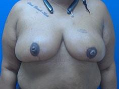 Jon Paul Trevisani, MD breast reduction after — Maitland, FL