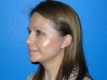 Jon Paul Trevisani, MD facelift after — Maitland, FL