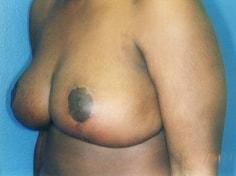 Jon Paul Trevisani, MD breast reduction after — Maitland, FL