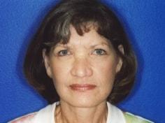 Jon Paul Trevisani, MD facelift after — Maitland, FL
