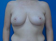 Jon Paul Trevisani, MD breast lift after — Maitland, FL