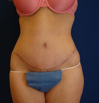 Brzowski Plastic Surgery body contouring after — Salt Lake City, UT