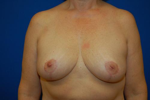 Brzowski Plastic Surgery breast reduction after — Ogden, UT