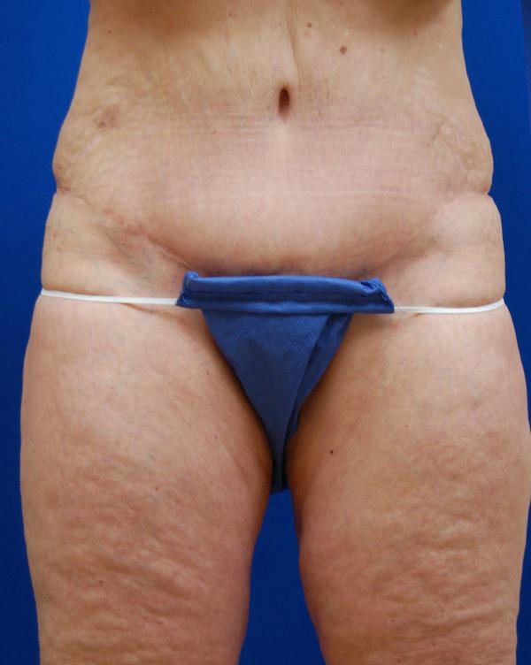 Mini Tummy Tuck after at Brzowski Plastic Surgery in Ogden, UT