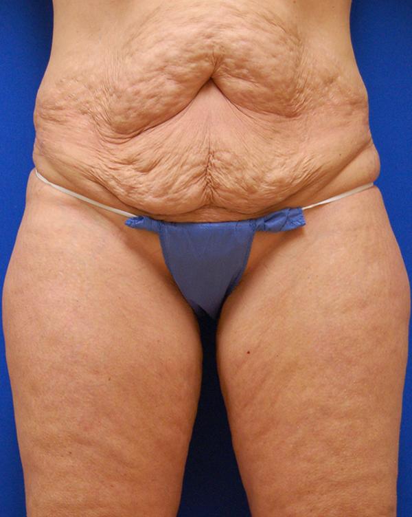 Mini Tummy Tuck before at Brzowski Plastic Surgery in Ogden, UT