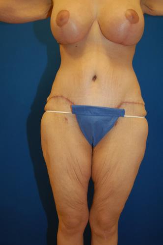 Tummy Tuck after at Brzowski Plastic Surgery in Salt Lake City, UT