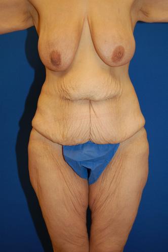 Tummy Tuck before at Brzowski Plastic Surgery in Salt Lake City, UT