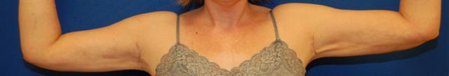 Arm Lift after at Brzowski Plastic Surgery in Ogden, UT