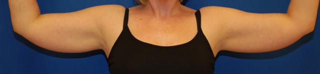 Arm Lift before at Brzowski Plastic Surgery in Ogden, UT