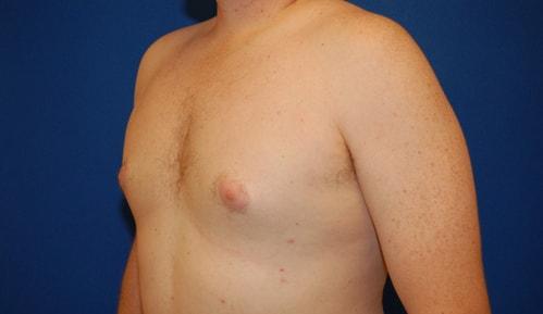 Gynecomastia Surgery after at Brzowski Plastic Surgery in Ogden, UT