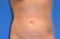 Brzowski Plastic Surgery liposuction after — Salt Lake City, UT