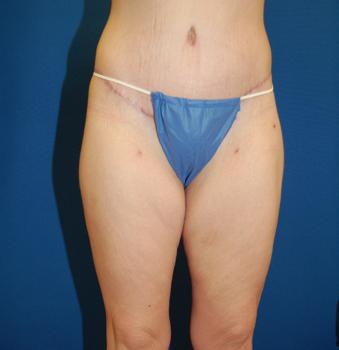 Thigh Lift after at Brzowski Plastic Surgery in Salt Lake City, UT
