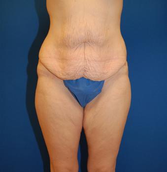 Thigh Lift before at Brzowski Plastic Surgery in Salt Lake City, UT