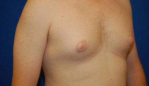 Gynecomastia Surgery before at Brzowski Plastic Surgery in Ogden, UT