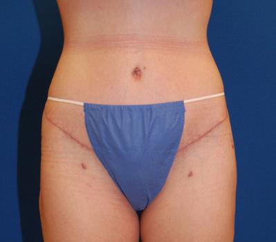 Brzowski Plastic Surgery body contouring after — Salt Lake City, UT