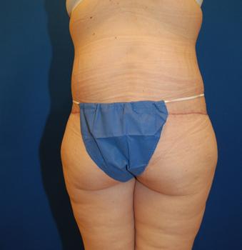 Brzowski Plastic Surgery body contouring after — Salt Lake City, UT