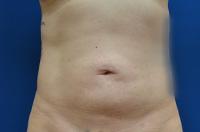 Brzowski Plastic Surgery liposuction after — Salt Lake City, UT