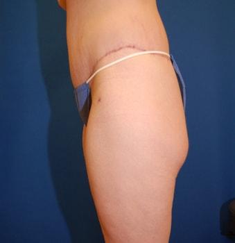 Brzowski Plastic Surgery body lift after — Ogden, UT