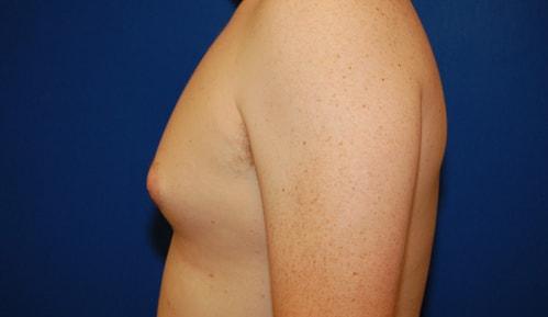 Gynecomastia Surgery before at Brzowski Plastic Surgery in Ogden, UT