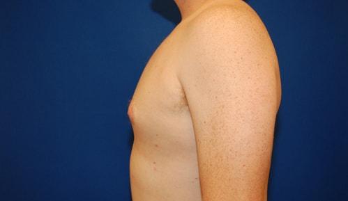 Gynecomastia Surgery after at Brzowski Plastic Surgery in Ogden, UT