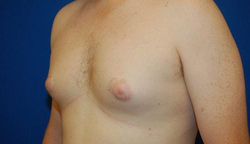 Gynecomastia Surgery before at Brzowski Plastic Surgery in Ogden, UT