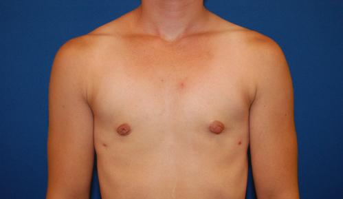 Brzowski Plastic Surgery gynecomastia after — Salt Lake City, UT
