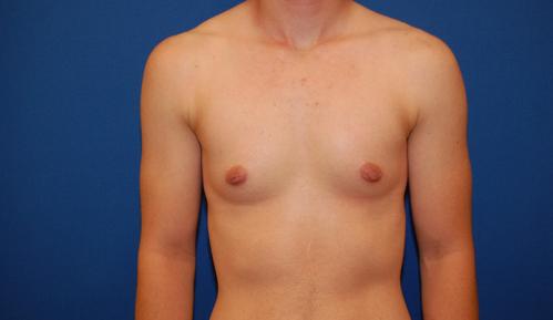 Gynecomastia Surgery before at Brzowski Plastic Surgery in Salt Lake City, UT