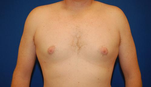Brzowski Plastic Surgery gynecomastia after — Salt Lake City, UT