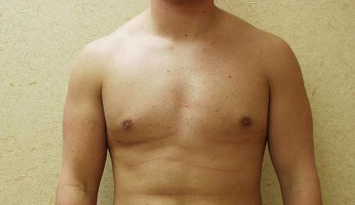 Brzowski Plastic Surgery gynecomastia after — Salt Lake City, UT