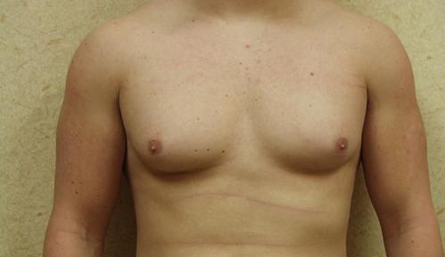 Gynecomastia Surgery before at Brzowski Plastic Surgery in Salt Lake City, UT