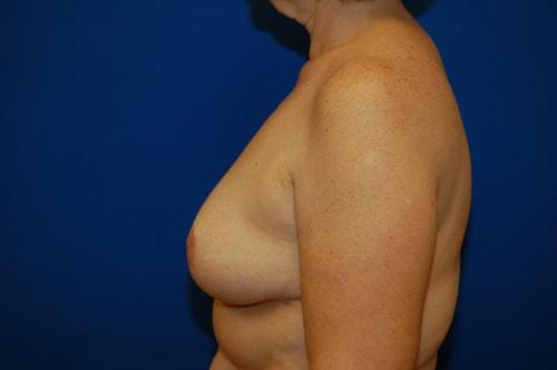 Brzowski Plastic Surgery breast reduction after — Ogden, UT