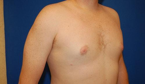 Gynecomastia Surgery after at Brzowski Plastic Surgery in Ogden, UT