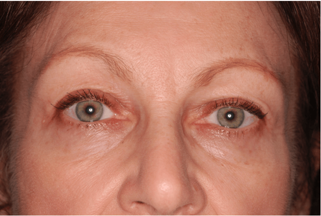 Blepharoplasty after at Leyngold Institute for Plastic Surgery in Meridian, ID