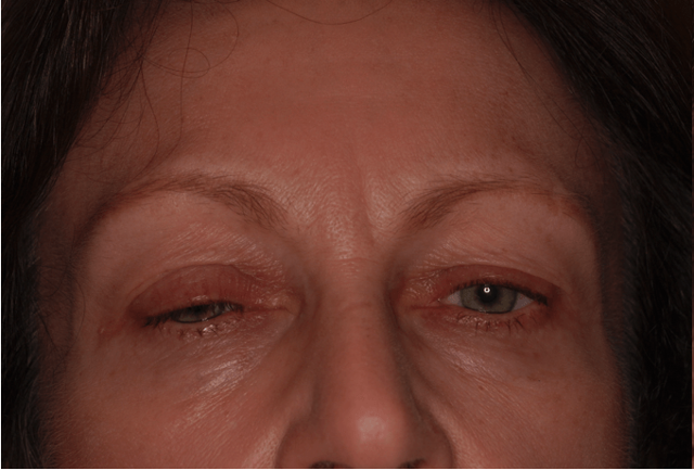 Blepharoplasty before at Leyngold Institute for Plastic Surgery in Meridian, ID