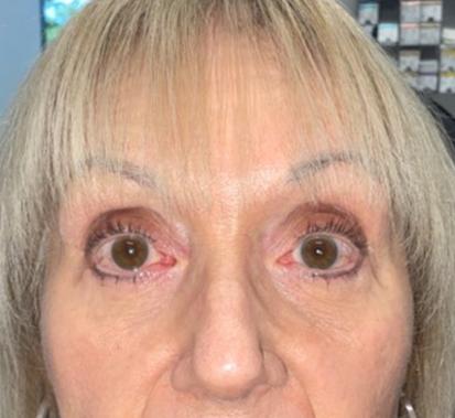 Blepharoplasty after at Leyngold Institute for Plastic Surgery in Meridian, ID
