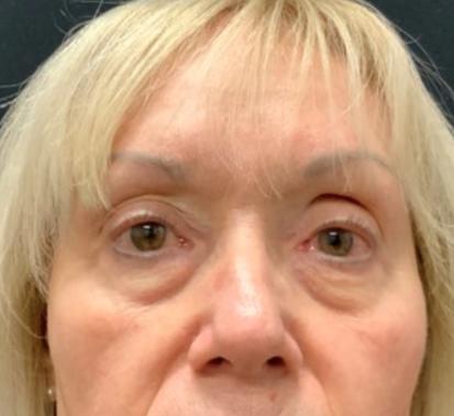 Blepharoplasty before at Leyngold Institute for Plastic Surgery in Meridian, ID