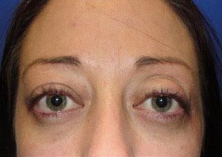 Blepharoplasty after at Leyngold Institute for Plastic Surgery in Meridian, ID