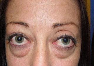 Blepharoplasty before at Leyngold Institute for Plastic Surgery in Meridian, ID