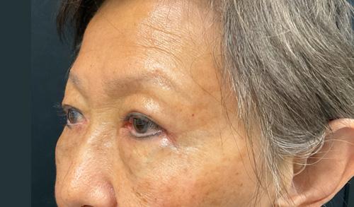 Blepharoplasty after at Leyngold Institute for Plastic Surgery in Meridian, ID