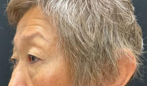 Blepharoplasty before at Leyngold Institute for Plastic Surgery in Meridian, ID