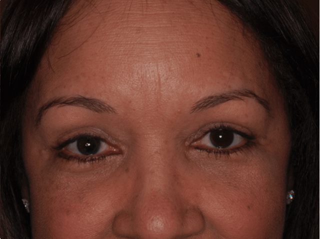 Blepharoplasty after at Leyngold Institute for Plastic Surgery in Meridian, ID