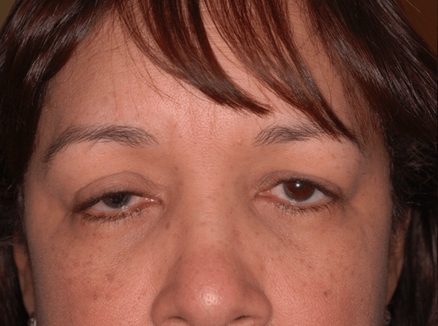 Blepharoplasty before at Leyngold Institute for Plastic Surgery in Meridian, ID