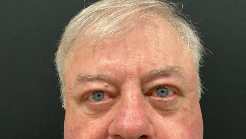 Leyngold Institute for Plastic Surgery blepharoplasty after — Meridian, ID