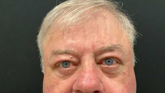 Blepharoplasty after at Leyngold Institute for Plastic Surgery in Meridian, ID
