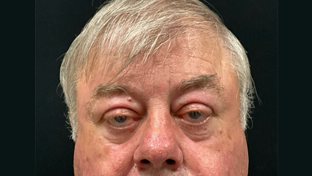 Blepharoplasty before at Leyngold Institute for Plastic Surgery in Meridian, ID