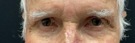 Blepharoplasty after at Leyngold Institute for Plastic Surgery in Meridian, ID