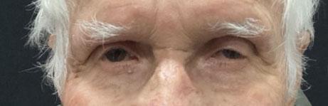 Blepharoplasty before at Leyngold Institute for Plastic Surgery in Meridian, ID