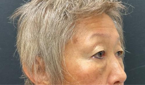 Blepharoplasty before at Leyngold Institute for Plastic Surgery in Meridian, ID
