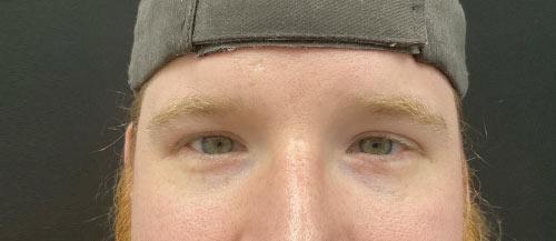 Blepharoplasty after at Leyngold Institute for Plastic Surgery in Meridian, ID