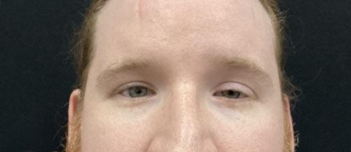 Blepharoplasty before at Leyngold Institute for Plastic Surgery in Meridian, ID